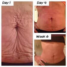 No Needles No Surgery Contact Me At Dlevans16 Ma Rr Com For Your Personal At Home Spa Like Me On Face Book Loose Skin Tighten Loose Skin Galvanic Body Spa