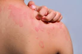 Image result for Hives
