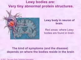 Lewy body dementia (lbd) is one of the most common types of progressive dementia. What Is Lewy Body Dementia Utah Aspen Senior Care