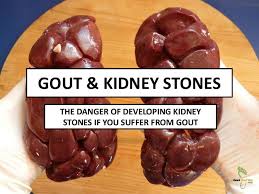 Gout And Kidney Stones Learn The Risks Gout Kidneystones Kidneydisease Uricacid Gout Remedies Gout How To Cure Gout