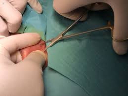 The cut ends of the vas may be tied, closed with a clip, or sealed by heat (cauterized). Quem Pode Fazer A Vasectomia Clinica Urodinamica Urologistas Em Sao Bernardo Do Campo