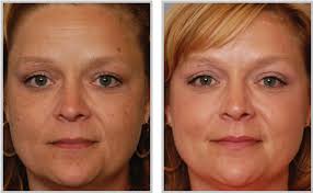 Pigment Correction Laser