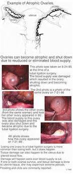 Symptoms Of Post Sterilization Syndrome And Post Tubal Ligation Syndrome Ptls