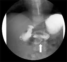 Image result for Midgut Volvulus