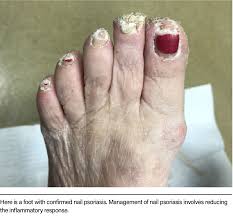Image result for Pitting nails feet