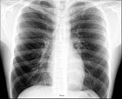 Upper thorax meaning in telugu; Thorax Wikipedia