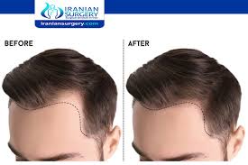 You can see around 50% of hair growth after hair transplant within the next 6 months. Unshaven Fue Hair Transplant Hair Transplant Without Shaving Head