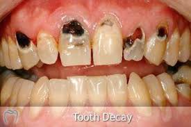 Traitements gingivite marginale, ulcéreuse, chroniques desquamative. Royal Monaco Medecine Des Caries Mortelles Royal Monaco Riviera Issn 2057 5076