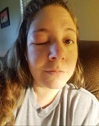 Reddit Beeks, she got my good eye! What are your worst sting stories, sting  count, or favorite remedies? : r/Beekeeping