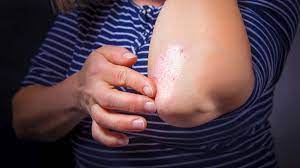 Psoriasis Arthritis Schuppenflechte Kann Auf Die Gelenke Gehen