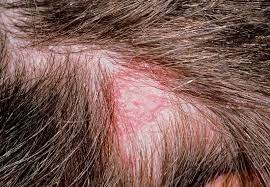 Hair loss due to abnormal secretion of sebum. Tinea Capitis Vs Seborrheic Dermatitis Ds Healthcare Group