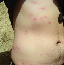 Image result for flea bites