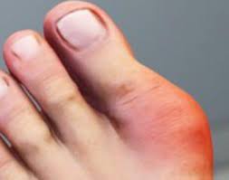 Image result for gout symptoms toe