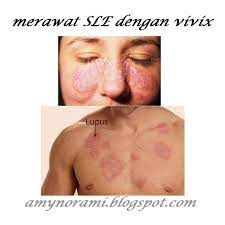 Penyakit ini terjadi akibat sistem kekebalan tubuh yang salah menyerang jaringan dan organ dalam tubuh yang sehat. Apakah Penyakit Sle Atau Lupus Dan Tanda Tanda Penyakit Ini Amynorami Com