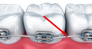 In cases where the wire is poking, you can cut the wire closest to the nearest bracket that is attached. What To Do If My Braces Wire Pokes Me Drs Savage Sabol Visser