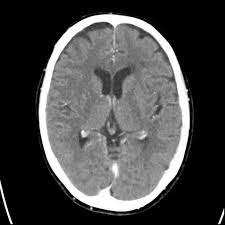 The scan lets them:learn the cancer's stage. Computertomographie Von Kopf Und Nasennebenhohlen Nnh Ct Ct Mrt Institut Berlin