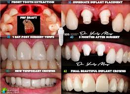 Image result for dental implant