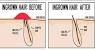 Shaving Ingrown Hair