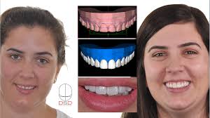 Patients can save on the expensive costs by knowing the best procedures in restorative. How Long Do Veneers Last City Dental