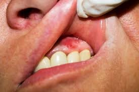 Image result for Periodontal Abscess