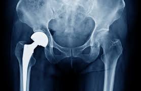 Image result for Hip XRay