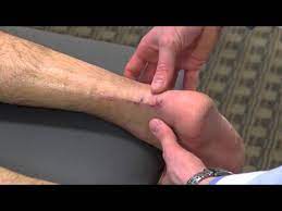 How to heal achilles tendon faster. Achilles Tendon Heals Faster With New Surgical Procedure Ohio State Sports Medicine Youtube