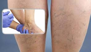 Varisli Damarlari Yok Etmenin Dogal Yontemi 2020 Dogal Dogal Saglik Saglik Ipuclari