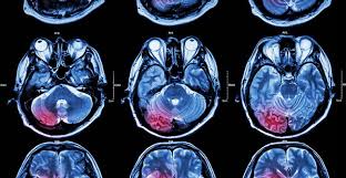 Maybe you would like to learn more about one of these? Tipuri De Tumori Cerebrale Cauze Si Simptome Neuroaxis