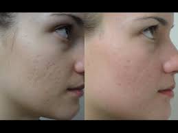 Cara menghilangkan jerawat dalam sekejap memang tidak mudah, dan tentunya kalau ada sangat diinginkan oleh setiap orang yang memiliki masalah pada bagaimana cara menghilangkan jerawat? Cara Make Up Muka Berlubang Saubhaya Makeup