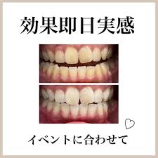 whitening check / ホワイトニングチェック