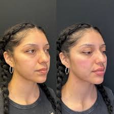 Just book the cheek filler with @annamarie_injects 😍😍😍 Schedule a free  consultation to discuss and formulate your individualized treatment plan.  📍Metamorph Medspa 👩🏻‍⚕️Anna Rush RN 🗺️ 960 Ohio Dr. Plano, Tx 75093