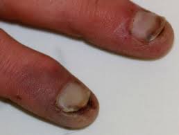 Dry gangrene | DermNet