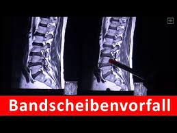 Check spelling or type a new query. Bandscheibenvorfall In Mrt Aufnahme By Radiologietv Youtube