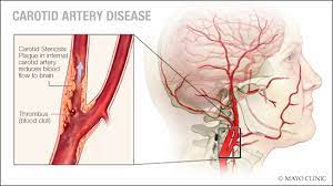Narrowing of a carotid artery (also called carotid artery stenosis) can increase the risk of stroke — the narrower the artery, the higher the risk. Carotid Disease Treatment Carotid Artery Blockage Surgery