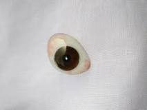 Image result for icd 10 code for artificial right eye prosthetic
