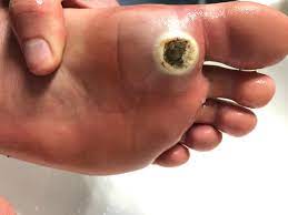 The skin on the wart may turn black in the first 1 to 2 days, which might signal that the skin cells in the wart are dying. The Moroccan Plantar Wart Saga Album On Imgur