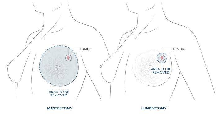 Visual comparison of mastectomy versus lumpectomy by Friedman Center