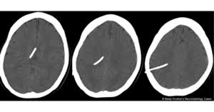 Ventriculoperitoneal Shunt Overdrainage Wikem