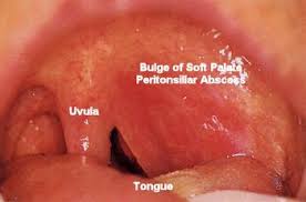 Image result for Peritonsillar Abscess