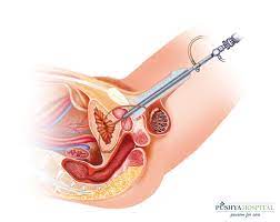 Urethral Stricture Treatment Ahmedabad | Best Urethral Stricture Specialist  in Ahmedabad