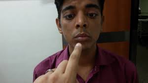 Mobius sign in the largest biology dictionary online. Thyroid Opthalmopathy Graves Disease Negative Lid Lag And Mobius Sign Youtube