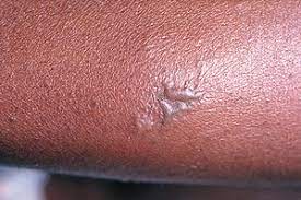 What happens if gonorrhea is left untreated. Gonorrhea Wikipedia