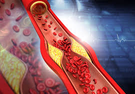 Arteriosklerose Wer Sich Richtig Ernahrt Schutzt Seine Gefasse