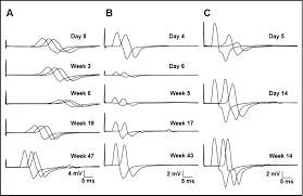 Gbs symptoms include muscle weakness, numbness, tingling, fatigue, pain, and gi issues. Guillain Barre Syndrome In Asia Journal Of Neurology Neurosurgery Psychiatry