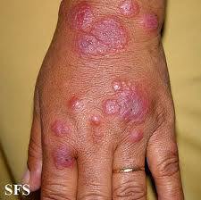 Image result for Erythema Multiforme Major