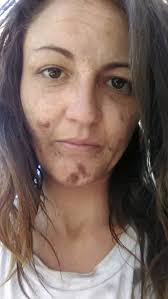 Did you know? Pfeiffer's Syndrome is a rare genetic condition where some of  the bones in the skull fuse too early a process called craniosynostosis.  This early fusion can affect the shape