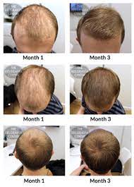 My hair loss started not long after hitting 15 and getting a very greasy scalp. Confusion Over Seborrhoeic Dermatitis And Seborrhoeic Alopecia