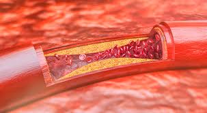 On sait, en effet, accéder aux coronaires par plusieurs voies. Pontages Coronariens Chirurgien Cardio Vasculaire Nimes Gard