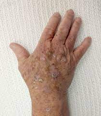 Skin cancer is the most common type of cancer in the united states by a pretty large margin, and it does not discriminate. Actinic Keratosis Wikipedia