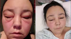 Their hair dye contains henna as the main ingredient, which is a natural herbal colorant that is highly unlikely to cause allergies. Popular Hair Product Causes Severe Allergic Reaction 7news